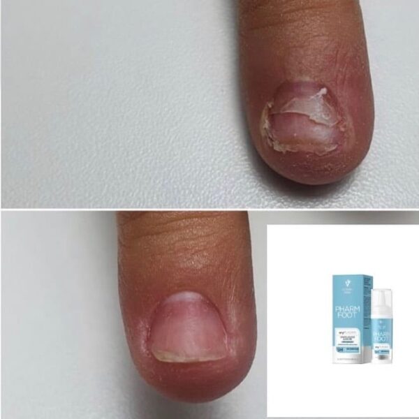 ⁦Pharm Foot | onlyPLASMA נוזל קולוסטרום לשיקום הציפורן לטיפול באוניכוליזיס⁩ – תמונה ⁦5⁩