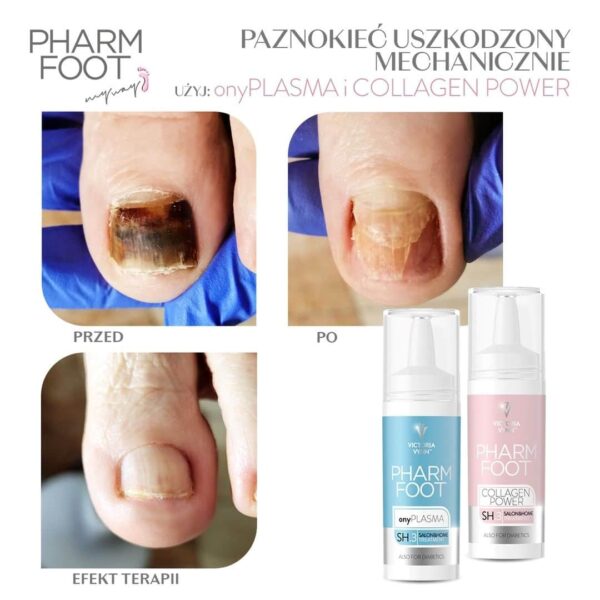 ⁦Pharm Foot | onlyPLASMA נוזל קולוסטרום לשיקום הציפורן לטיפול באוניכוליזיס⁩ – תמונה ⁦4⁩