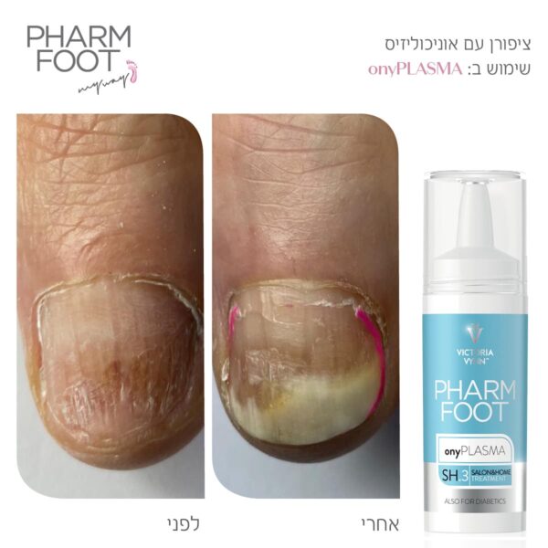 ⁦Pharm Foot | onlyPLASMA נוזל קולוסטרום לשיקום הציפורן לטיפול באוניכוליזיס⁩ – תמונה ⁦3⁩